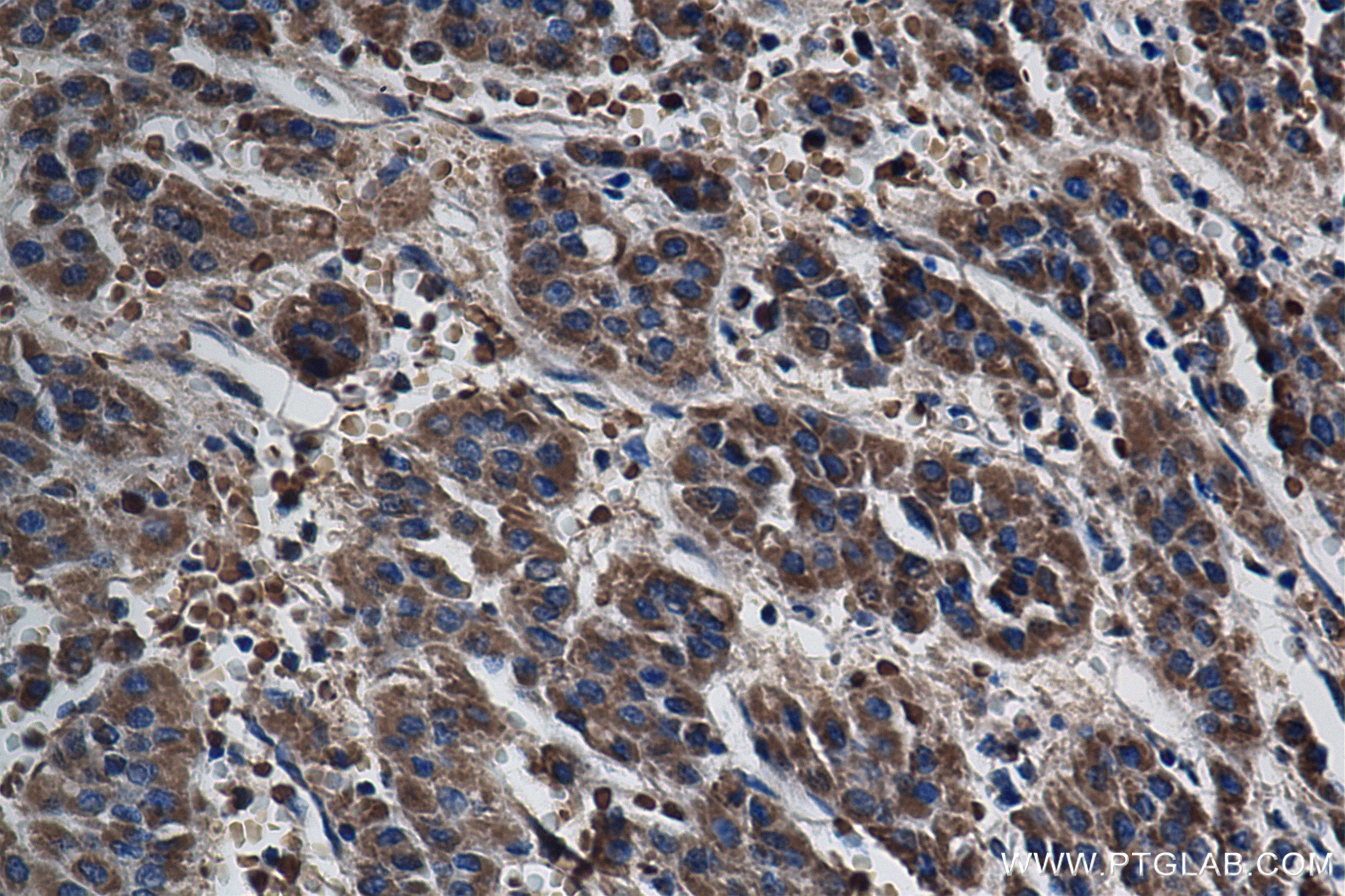 Immunohistochemistry (IHC) staining of Human Hepatocellular cancer using SHPK Recombinant antibody (82875-1-RR)