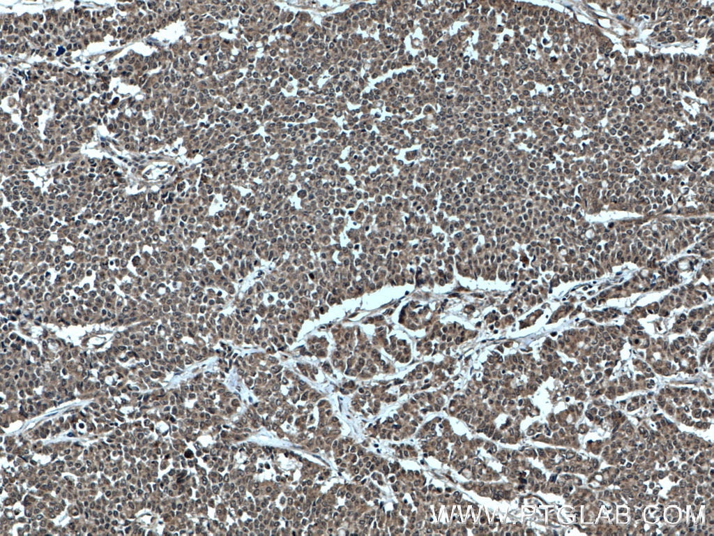 IHC staining of human colon cancer using 27020-1-AP