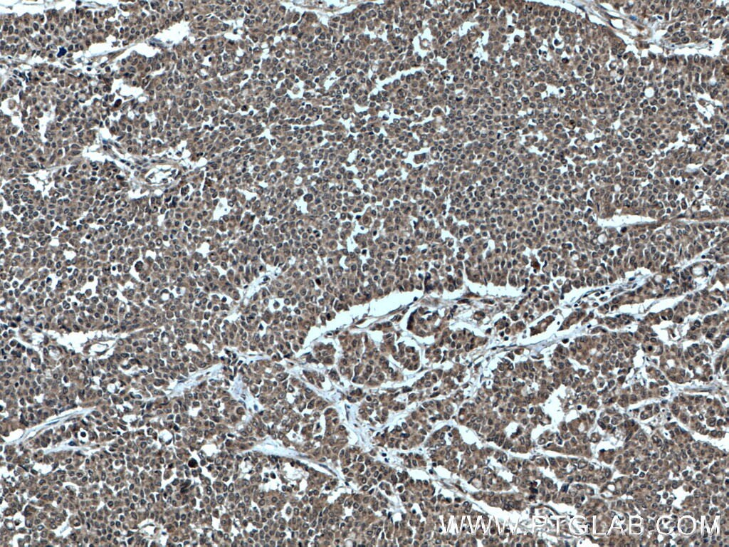 Immunohistochemistry (IHC) staining of human colon cancer tissue using SHQ1 Polyclonal antibody (27020-1-AP)