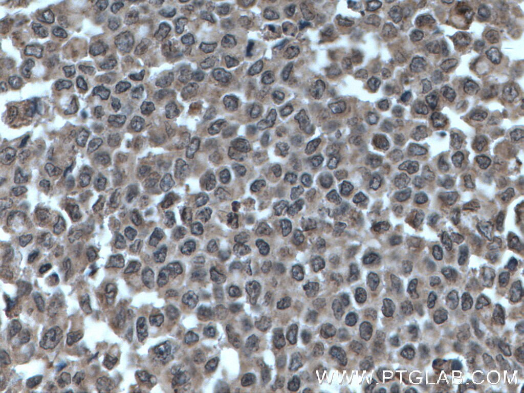 Immunohistochemistry (IHC) staining of human colon cancer tissue using SHQ1 Polyclonal antibody (27020-1-AP)