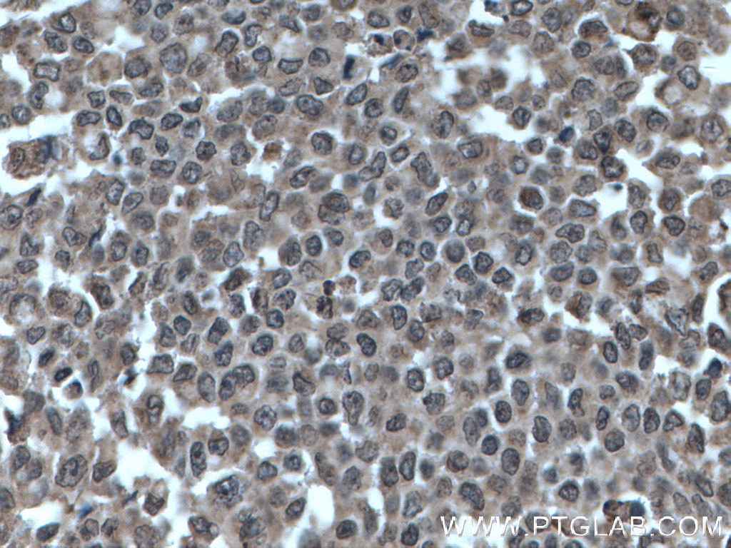 Immunohistochemistry (IHC) staining of human colon cancer tissue using SHQ1 Polyclonal antibody (27020-1-AP)