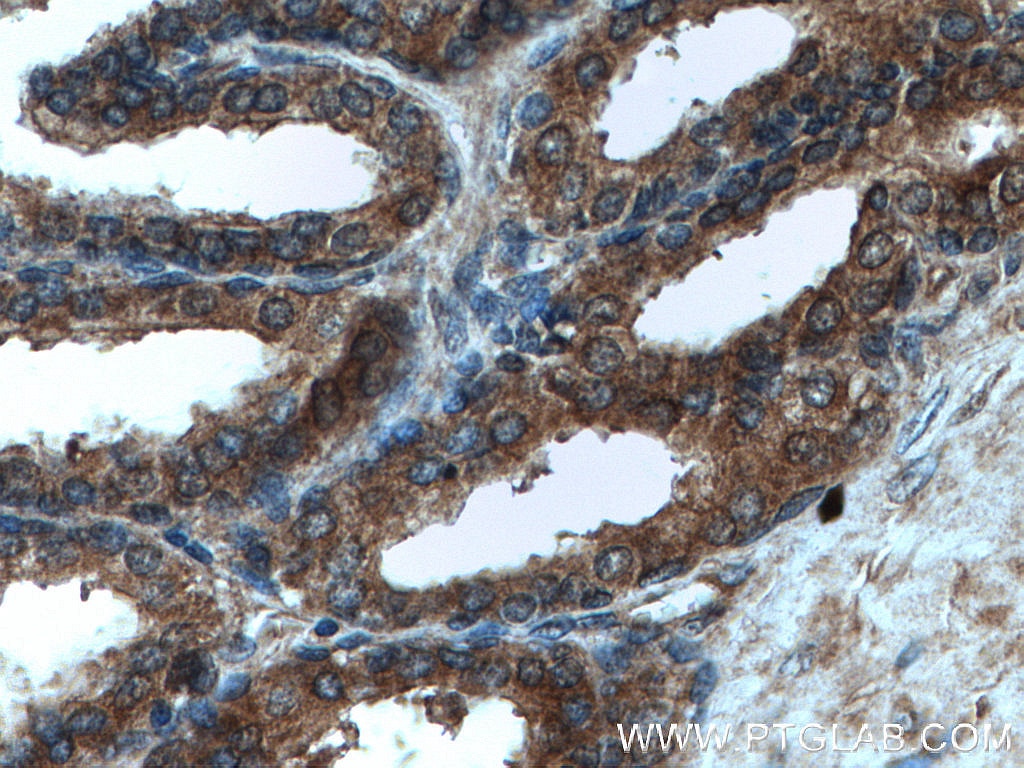 Immunohistochemistry (IHC) staining of human prostate hyperplasia tissue using SHQ1 Polyclonal antibody (27020-1-AP)