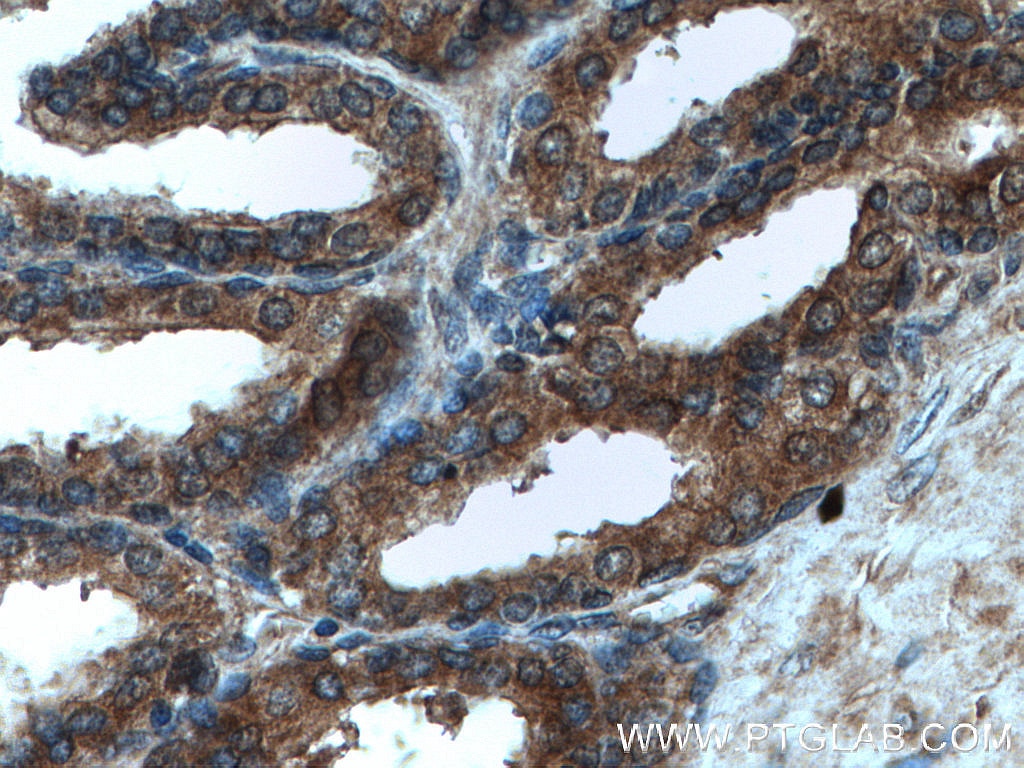 IHC staining of human prostate hyperplasia using 27020-1-AP