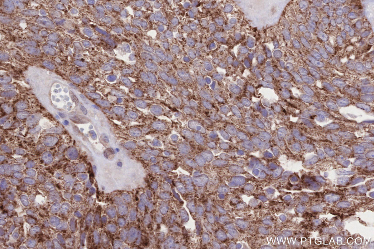 Immunohistochemistry (IHC) staining of human ovary cancer tissue using SIAH1 Recombinant monoclonal antibody (83389-4-RR)