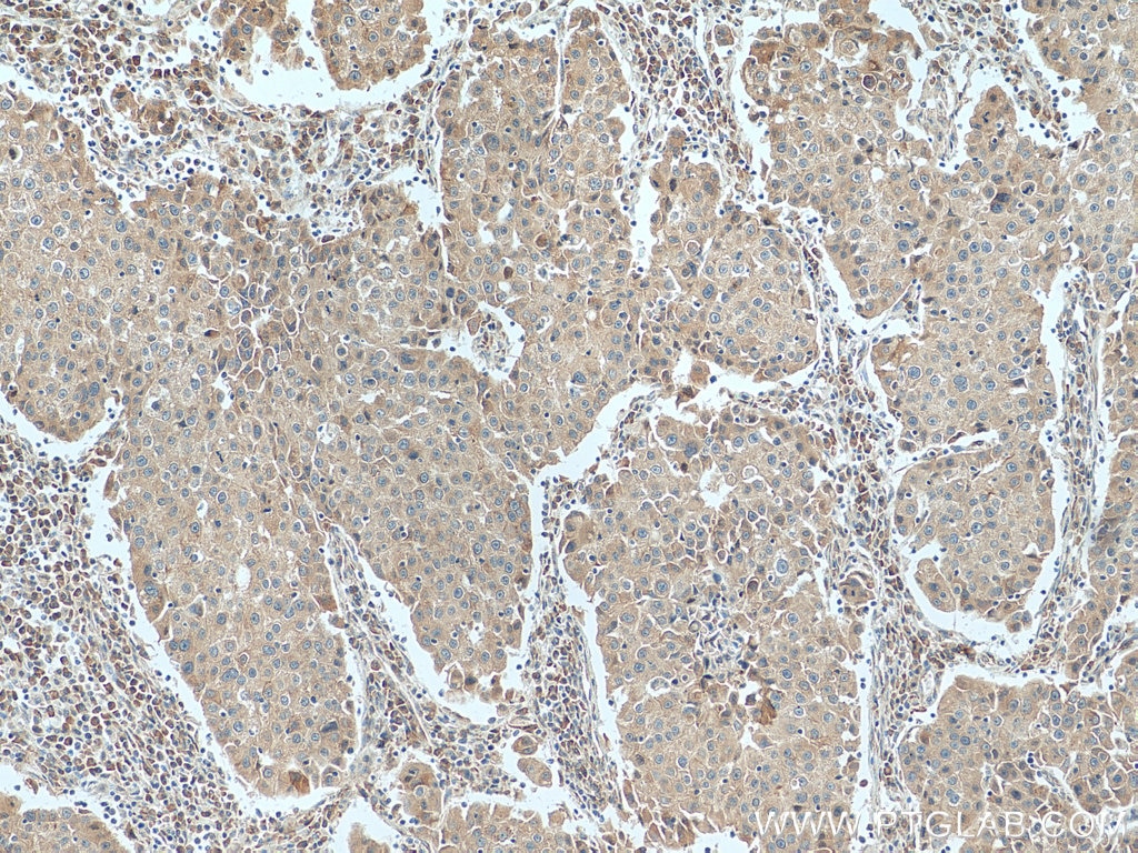 Immunohistochemistry (IHC) staining of human breast cancer tissue using SIDT1 Polyclonal antibody (55352-1-AP)