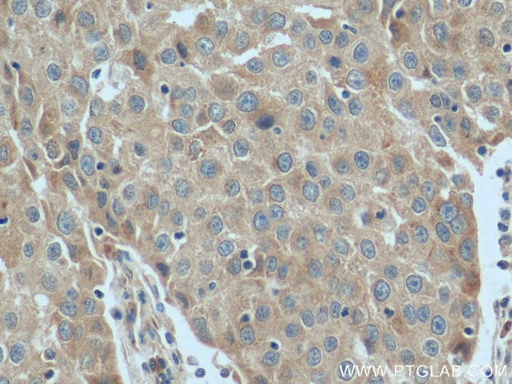 Immunohistochemistry (IHC) staining of human breast cancer tissue using SIDT1 Polyclonal antibody (55352-1-AP)