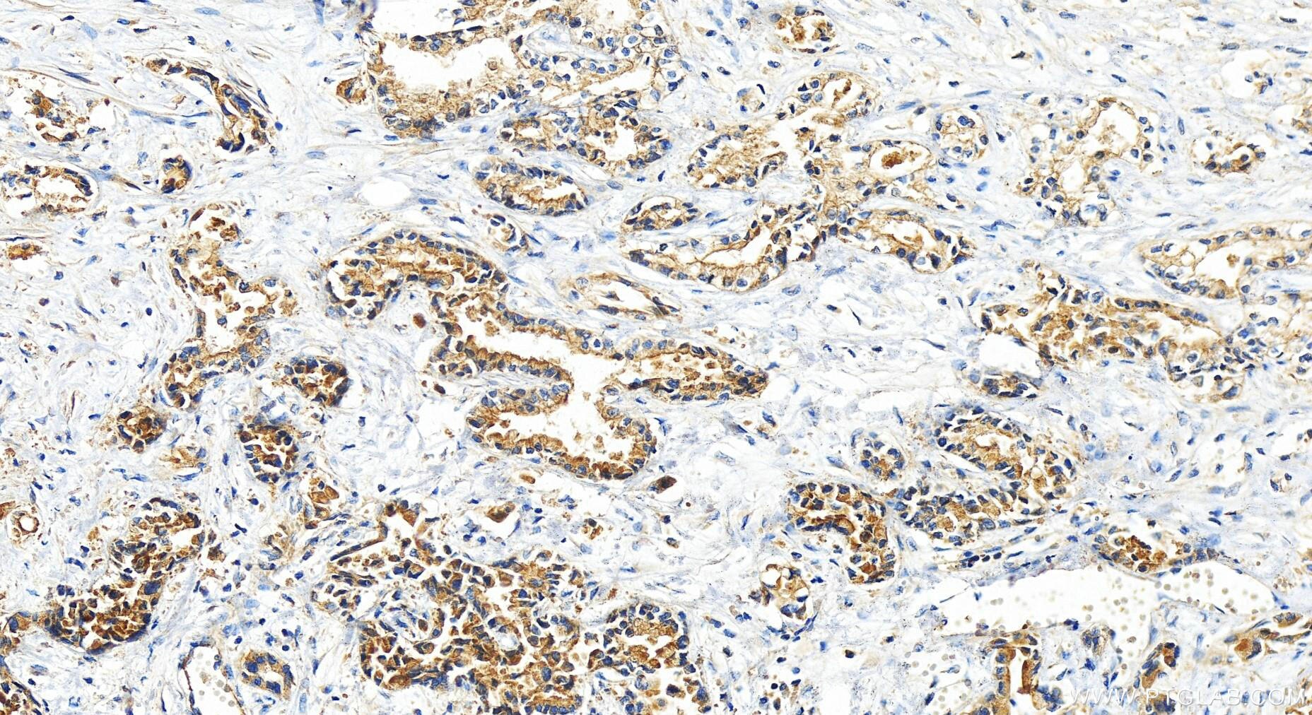 Immunohistochemistry (IHC) staining of human intrahepatic cholangiocarcinoma tissue using SIGIRR Polyclonal antibody (27828-1-AP)