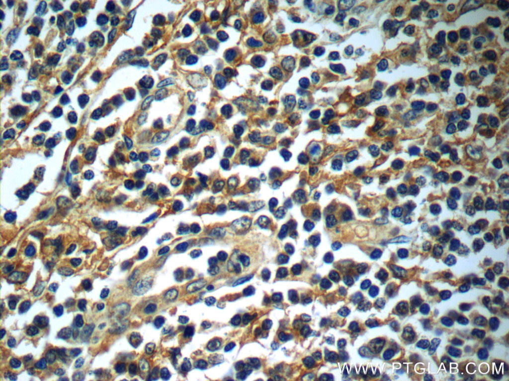 Immunohistochemistry (IHC) staining of human tonsillitis tissue using Siglec-7/CD328 Polyclonal antibody (13939-1-AP)