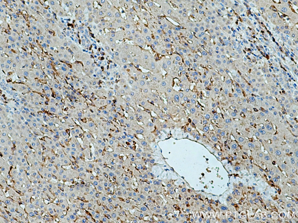 Immunohistochemistry (IHC) staining of human liver cancer tissue using Siglec-9 Polyclonal antibody (13377-1-AP)