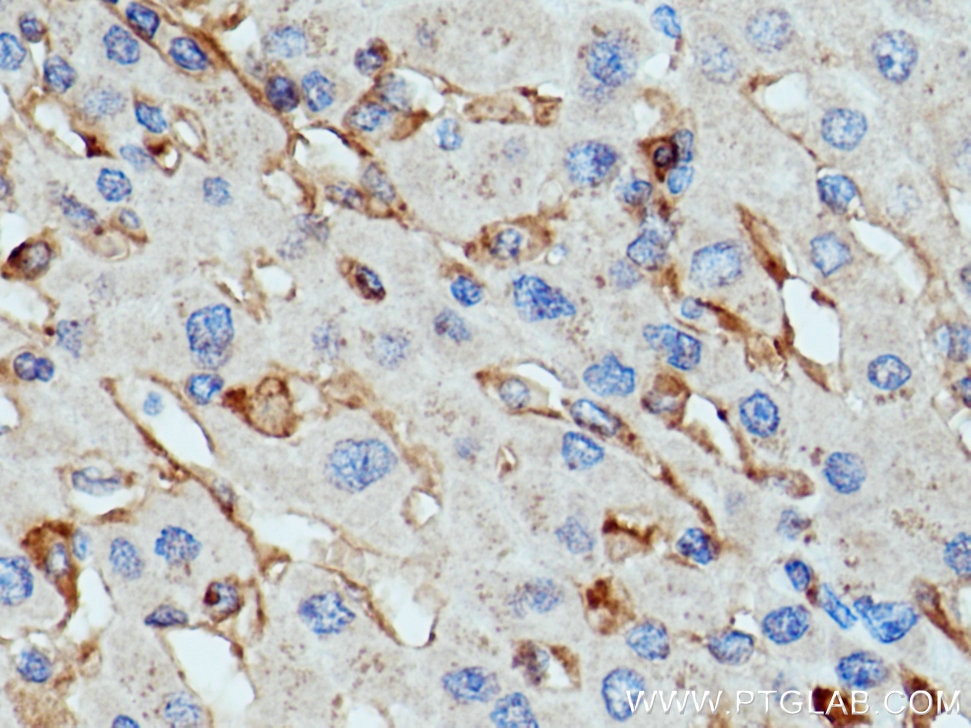 IHC staining of human liver cancer using 13377-1-AP
