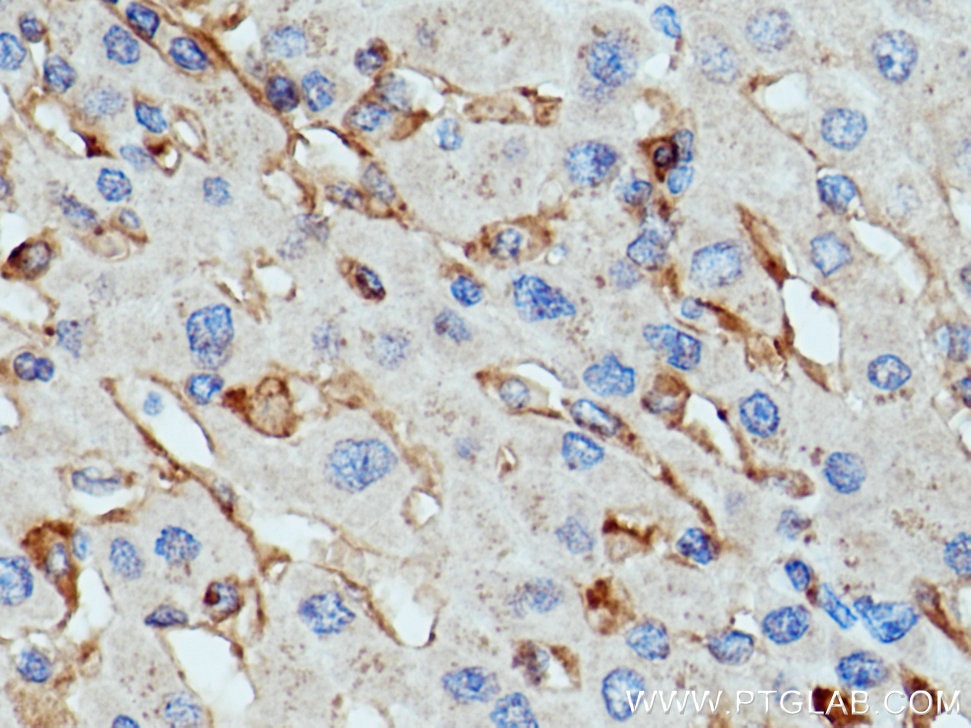 Immunohistochemistry (IHC) staining of human liver cancer tissue using Siglec-9 Polyclonal antibody (13377-1-AP)