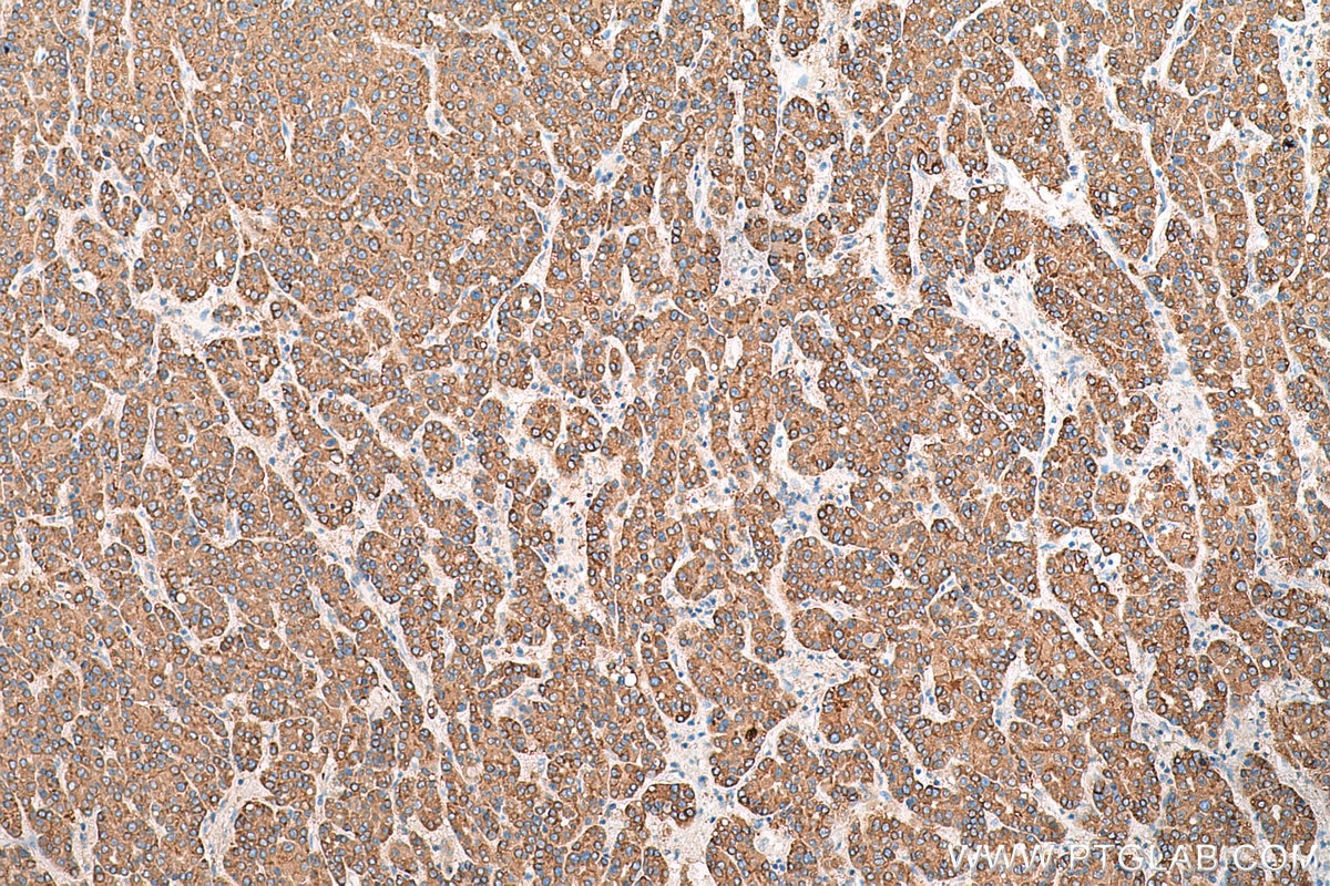 Immunohistochemistry (IHC) staining of human liver cancer tissue using SIGMAR1 Polyclonal antibody (15168-1-AP)