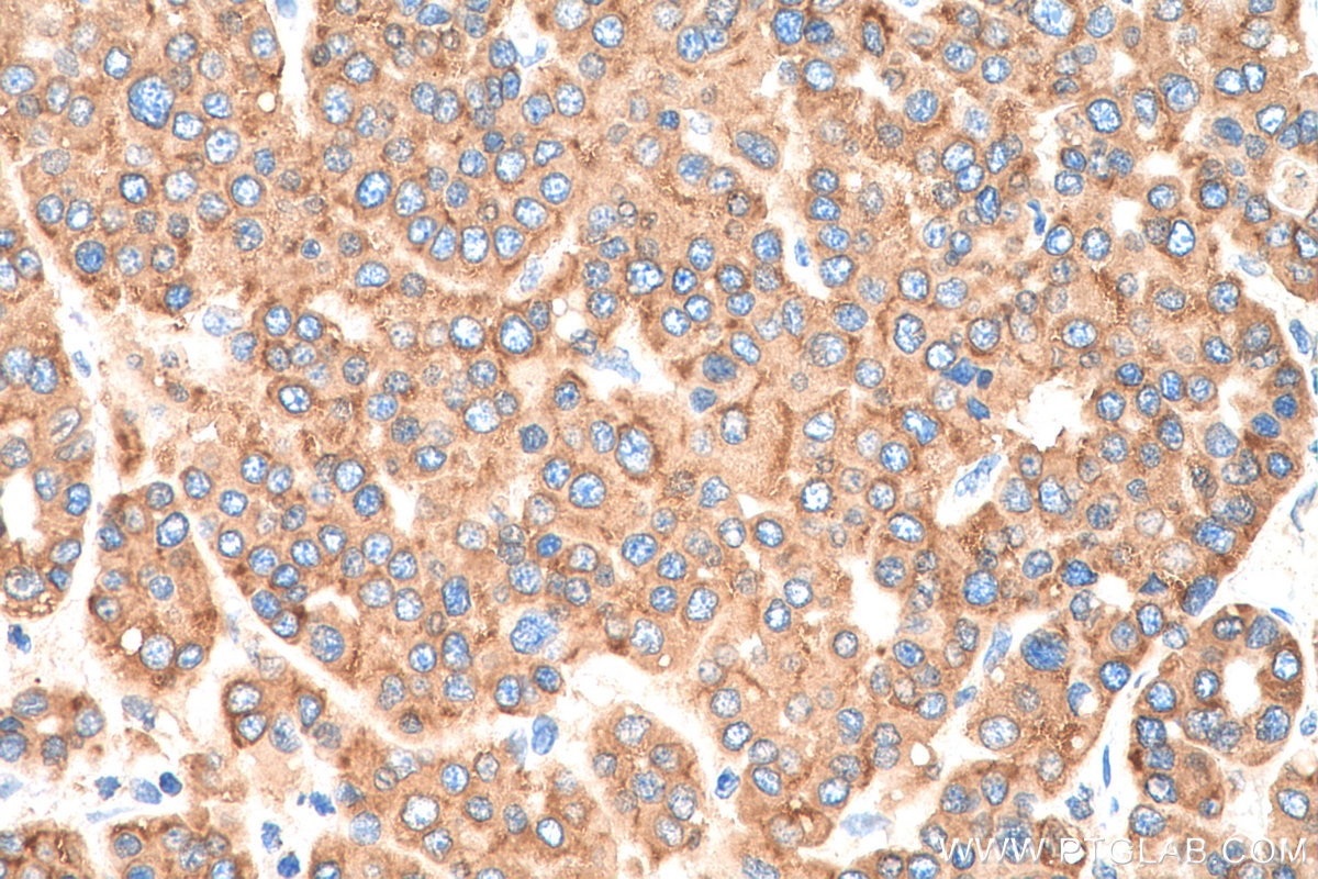 Immunohistochemistry (IHC) staining of human liver cancer tissue using SIGMAR1 Polyclonal antibody (15168-1-AP)