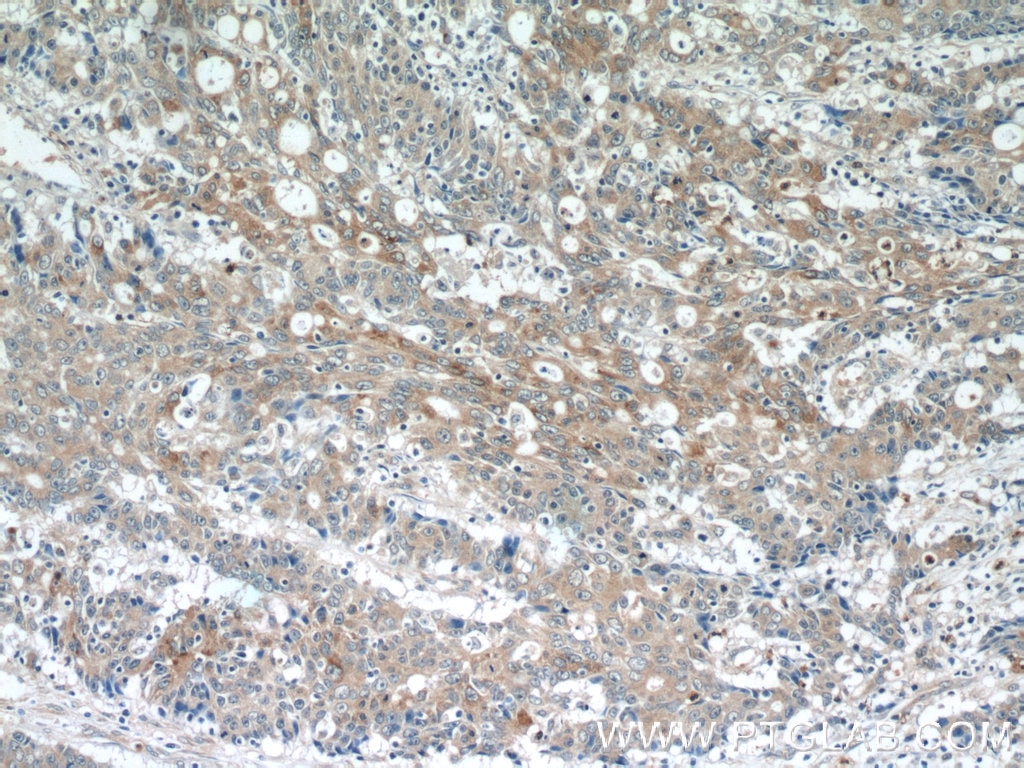 Immunohistochemistry (IHC) staining of human colon cancer tissue using SIK1 Polyclonal antibody (17370-1-AP)