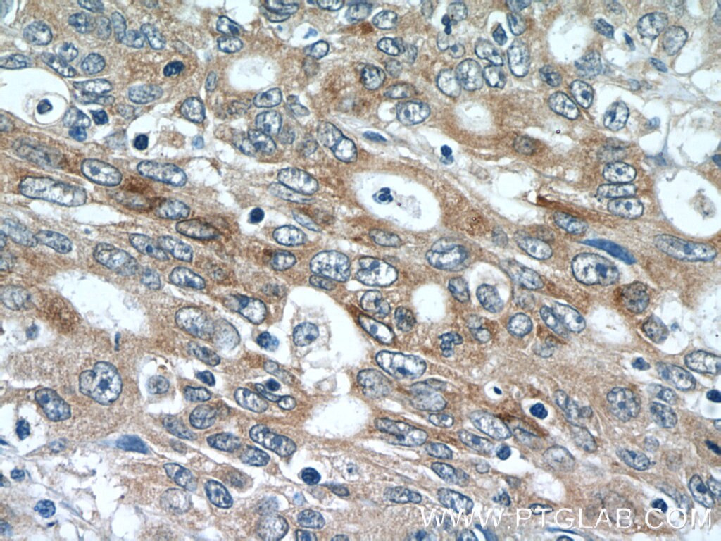 Immunohistochemistry (IHC) staining of human colon cancer tissue using SIK1 Polyclonal antibody (17370-1-AP)