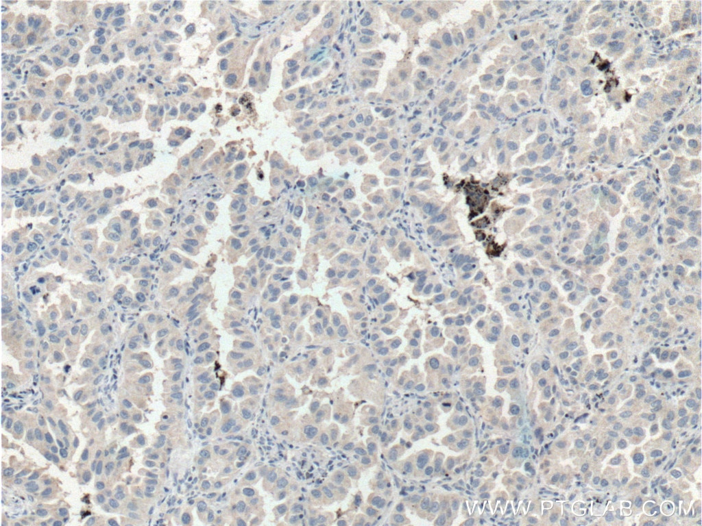 IHC staining of human lung cancer using 51045-1-AP