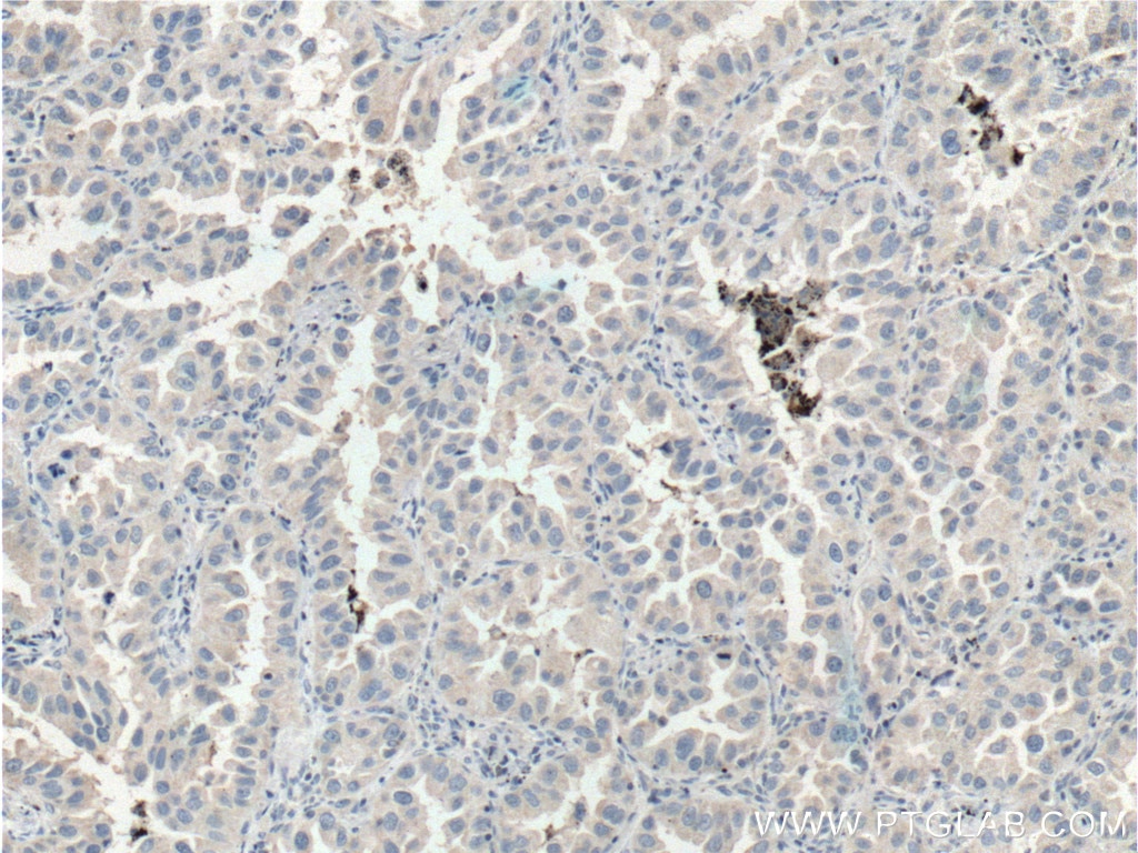 Immunohistochemistry (IHC) staining of human lung cancer tissue using SIK1 Polyclonal antibody (51045-1-AP)