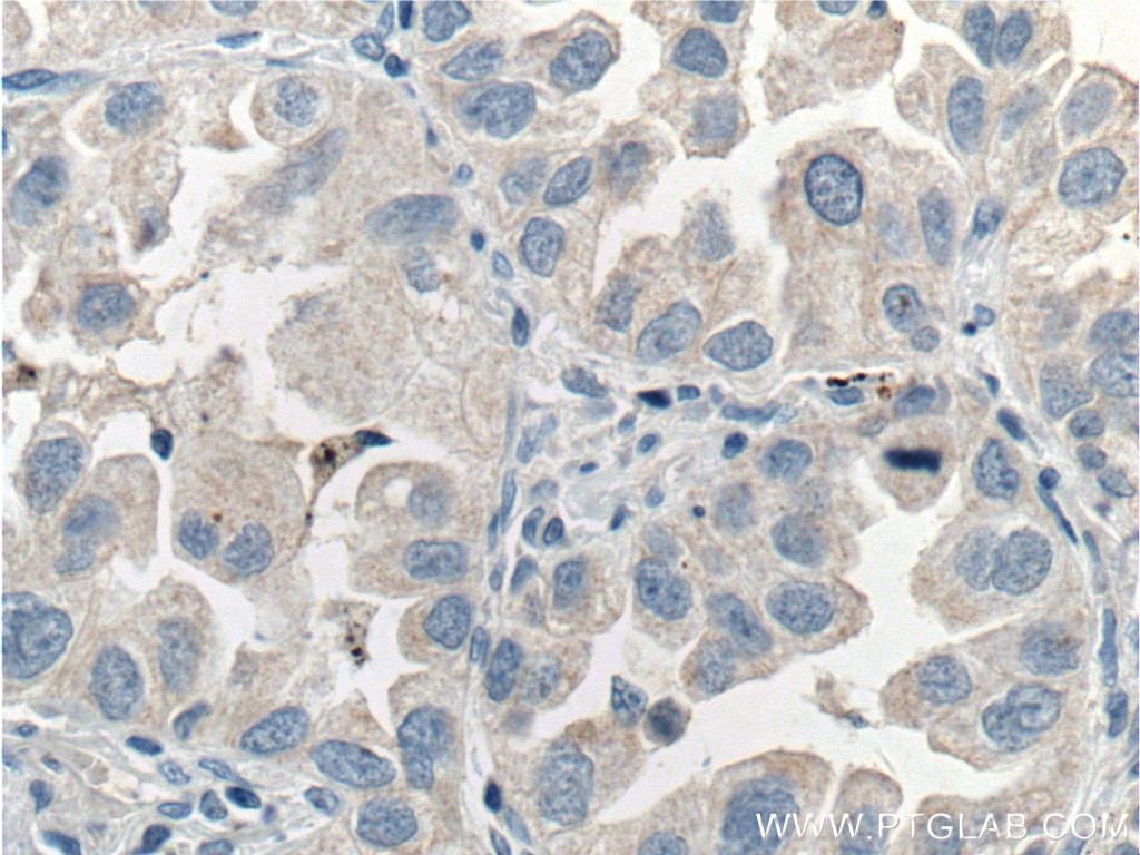 Immunohistochemistry (IHC) staining of human lung cancer tissue using SIK1 Polyclonal antibody (51045-1-AP)