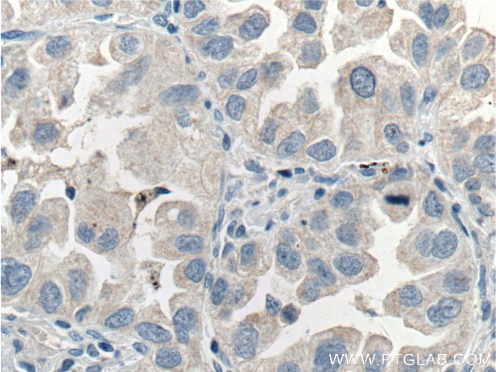 IHC staining of human lung cancer using 51045-1-AP