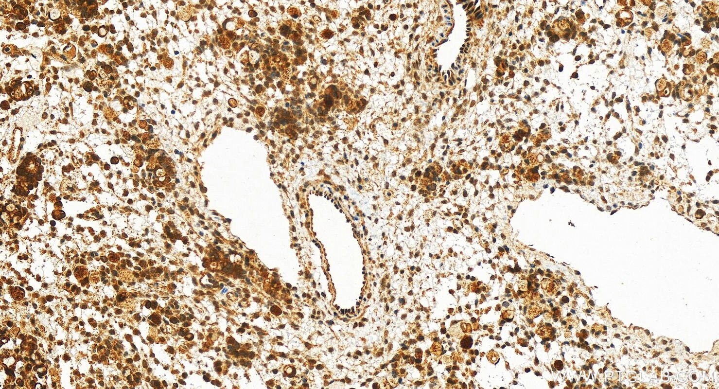 Immunohistochemistry (IHC) staining of human ovary cancer tissue using SIK2 Polyclonal antibody (27608-1-AP)
