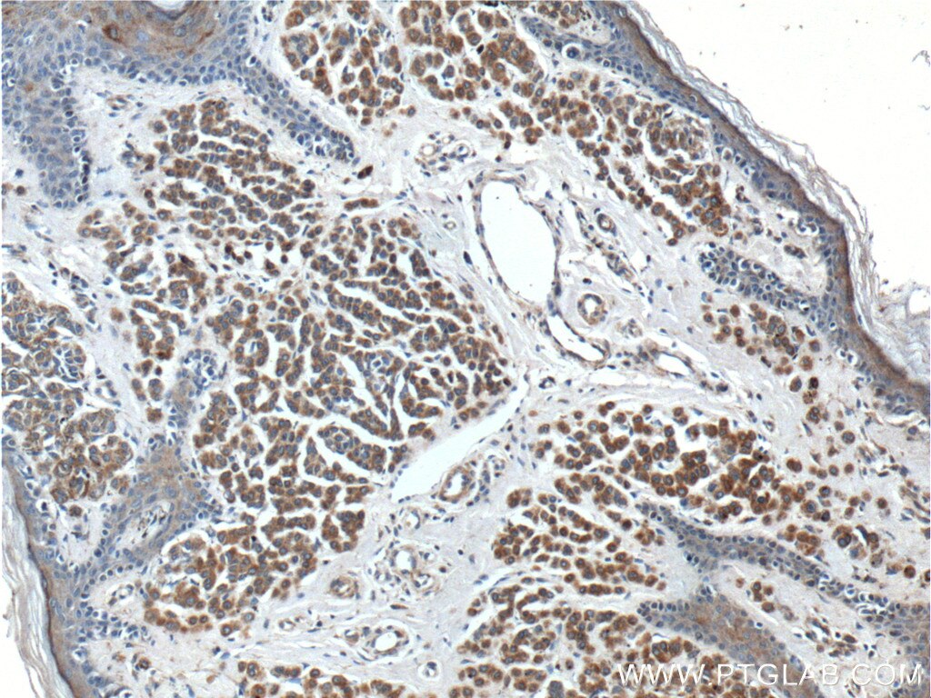 Immunohistochemistry (IHC) staining of human malignant melanoma tissue using SILV Polyclonal antibody (27329-1-AP)