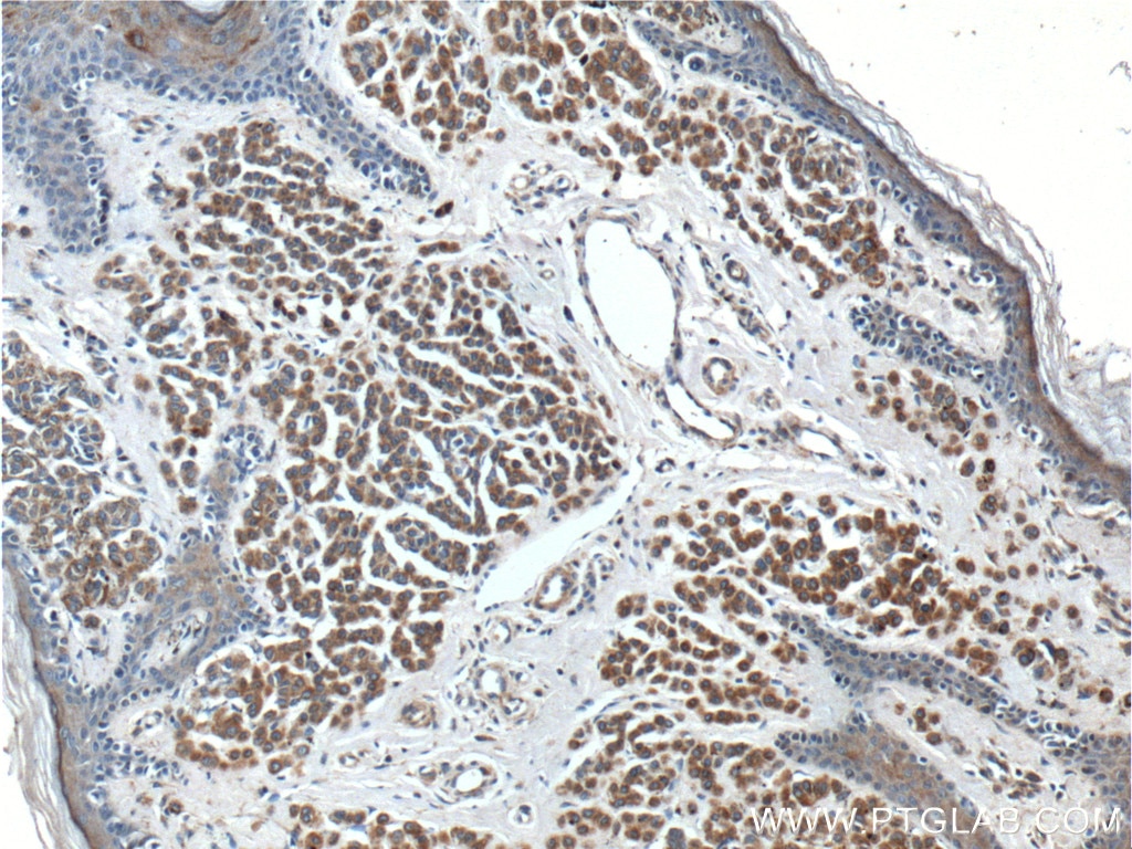 IHC staining of human malignant melanoma using 27329-1-AP