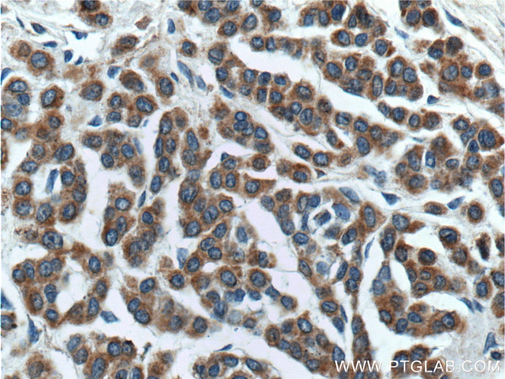 Immunohistochemistry (IHC) staining of human malignant melanoma tissue using SILV Polyclonal antibody (27329-1-AP)