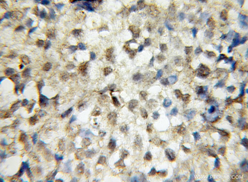 Immunohistochemistry (IHC) staining of human ovary tumor tissue using SIPA1L2 Polyclonal antibody (12674-1-AP)
