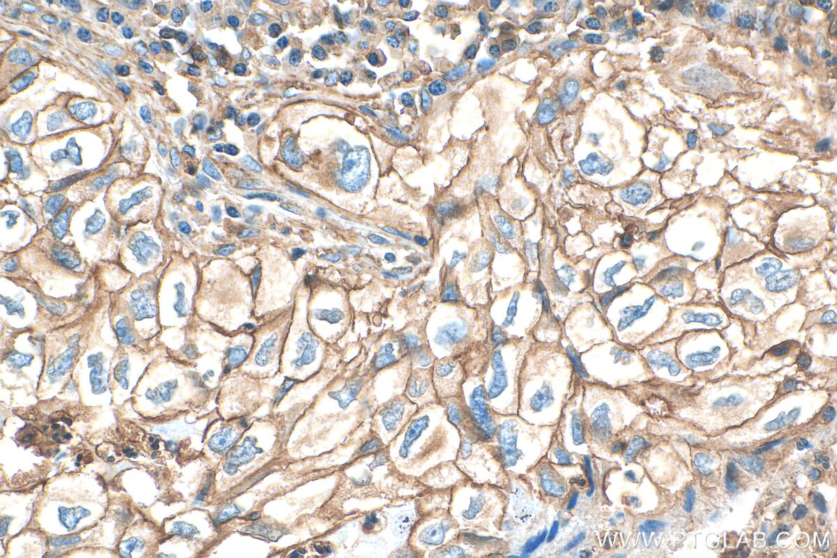 Immunohistochemistry (IHC) staining of human lung cancer tissue using SIRP Beta 1 Monoclonal antibody (68206-1-Ig)