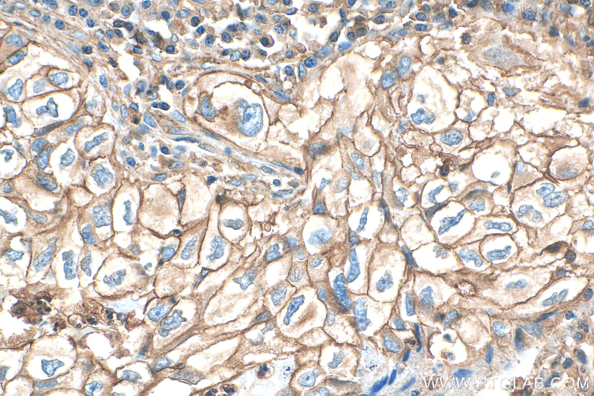 Immunohistochemistry (IHC) staining of human lung cancer tissue using SIRP beta 1/CD172b Monoclonal antibody (68206-1-Ig)