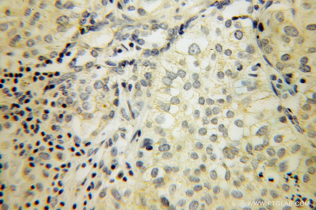 Immunohistochemistry (IHC) staining of human lung cancer tissue using SIRP Beta 1 Polyclonal antibody (11811-1-AP)