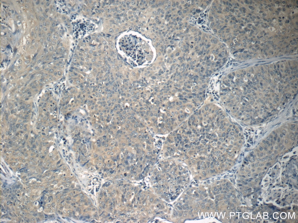 Immunohistochemistry (IHC) staining of human lung cancer tissue using SIRT1 Polyclonal antibody (13161-1-AP)