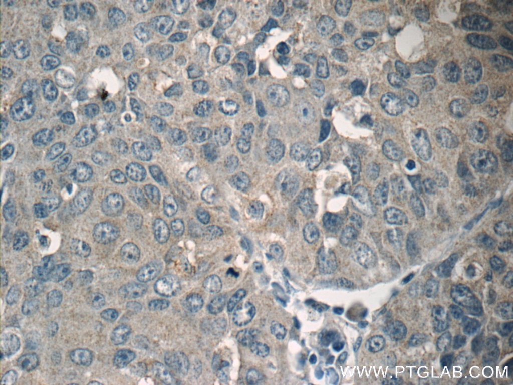 Immunohistochemistry (IHC) staining of human lung cancer tissue using SIRT1 Polyclonal antibody (13161-1-AP)