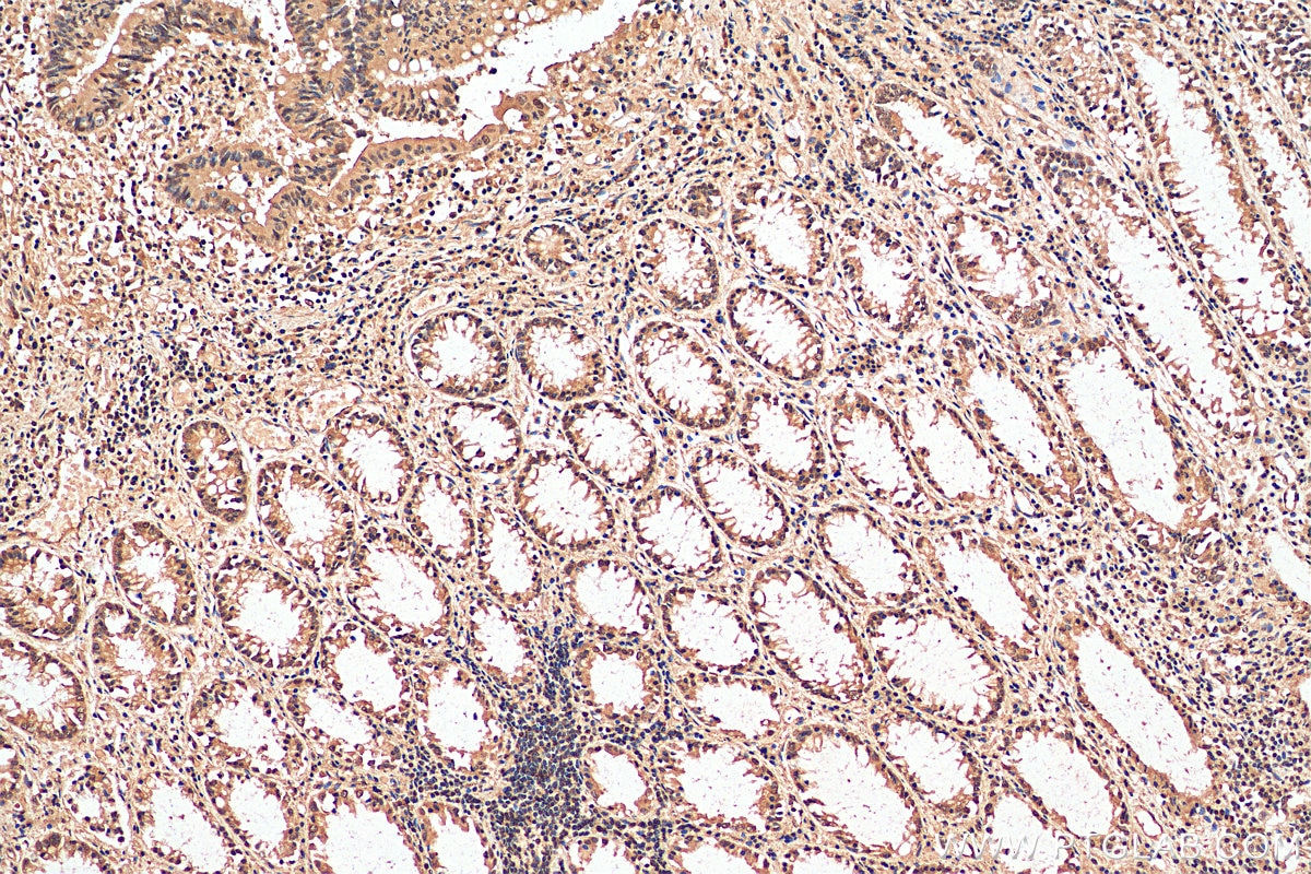 Immunohistochemistry (IHC) staining of human colon cancer tissue using SIRT1 Polyclonal antibody (13161-1-AP)