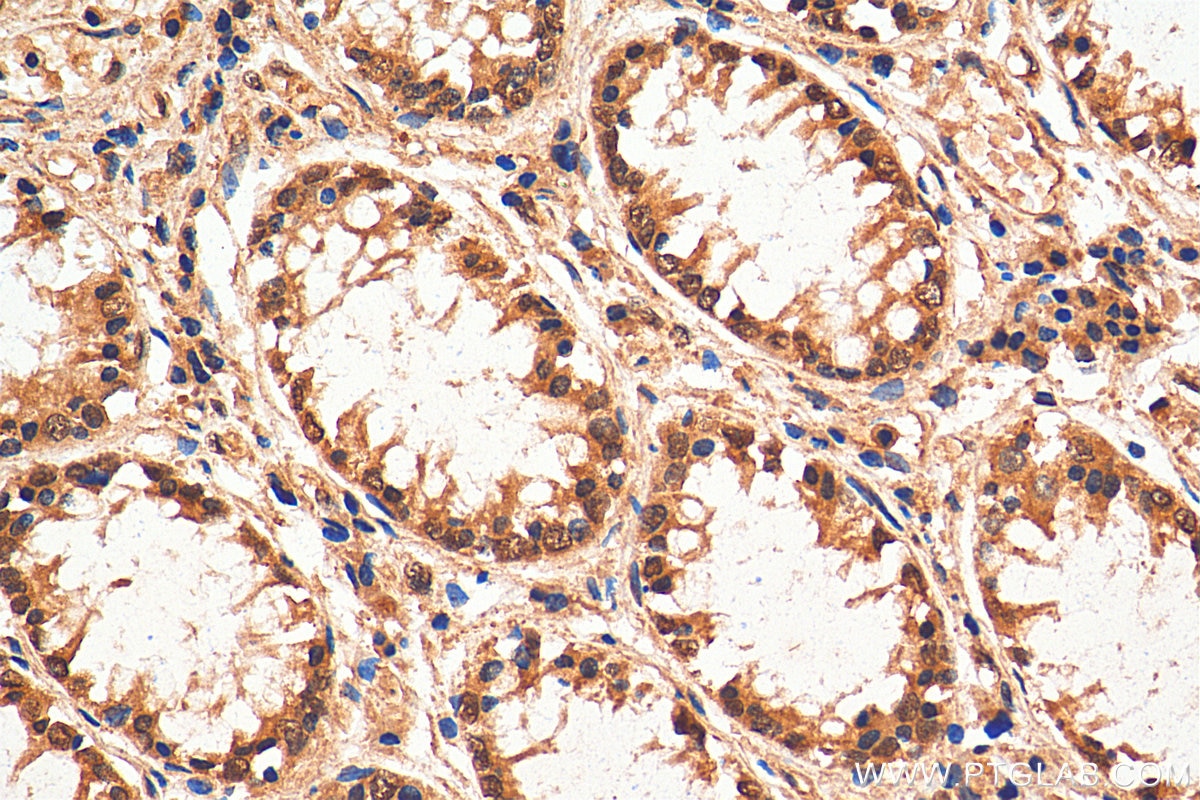 IHC staining of human colon cancer using 13161-1-AP