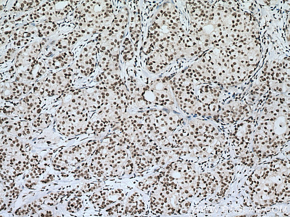 Immunohistochemistry (IHC) staining of human breast cancer tissue using SIRT1 Monoclonal antibody (60303-1-Ig)