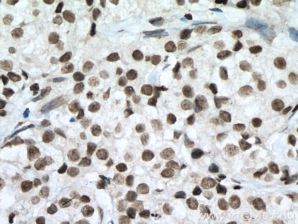Immunohistochemistry (IHC) staining of human breast cancer tissue using SIRT1 Monoclonal antibody (60303-1-Ig)