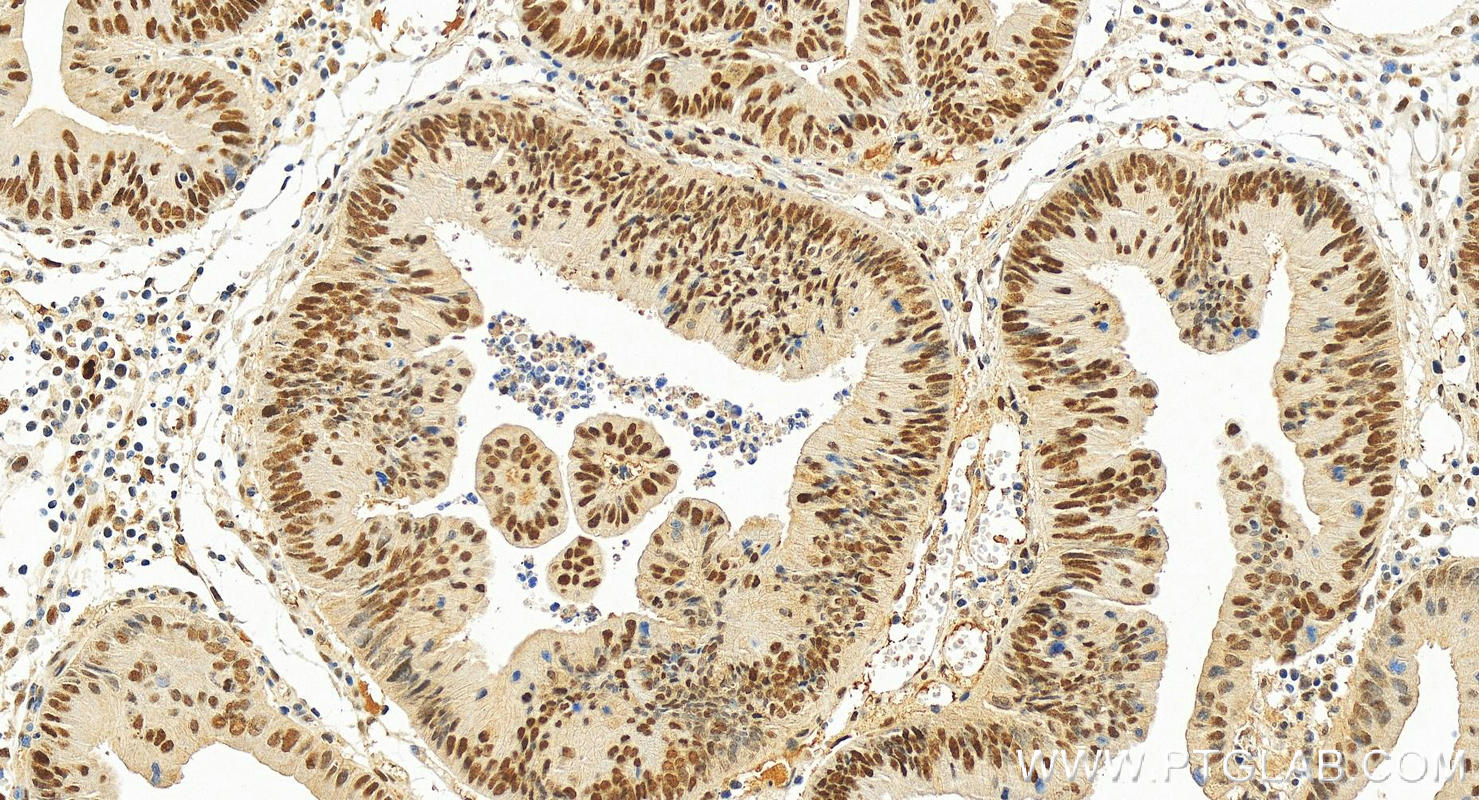 Immunohistochemistry (IHC) staining of human colon cancer tissue using Multi-rAb™ SIRT1 Multi-Recombinant antibody (RMX00009)