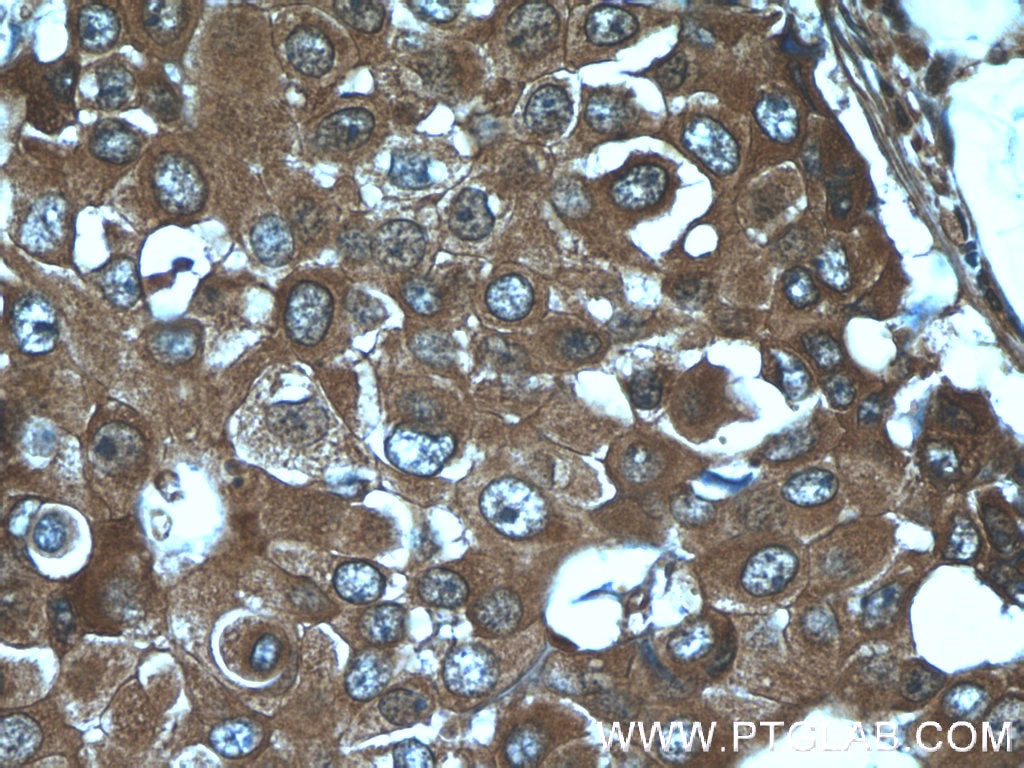 IHC staining of human breast cancer using 15345-1-AP