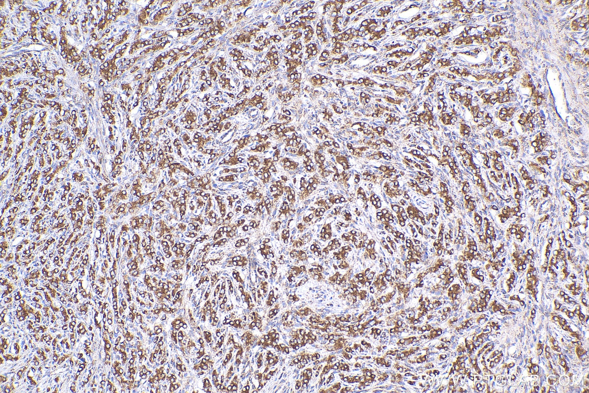 Immunohistochemistry (IHC) staining of human prostate cancer tissue using SIRT3 Polyclonal antibody (29838-1-AP)