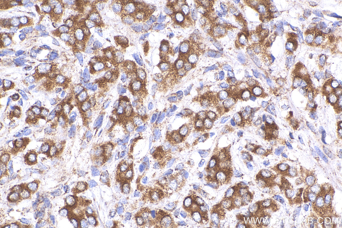 Immunohistochemistry (IHC) staining of human prostate cancer tissue using SIRT3 Polyclonal antibody (29838-1-AP)
