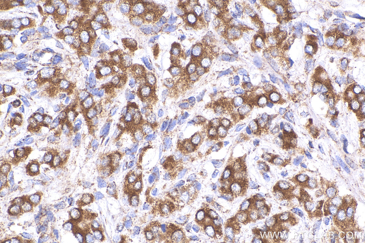 IHC staining of human prostate cancer using 29838-1-AP