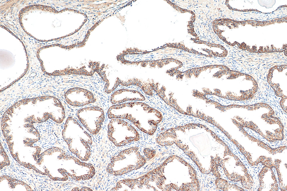 Immunohistochemistry (IHC) staining of human prostate cancer tissue using SIRT3 Recombinant antibody (82210-1-RR)