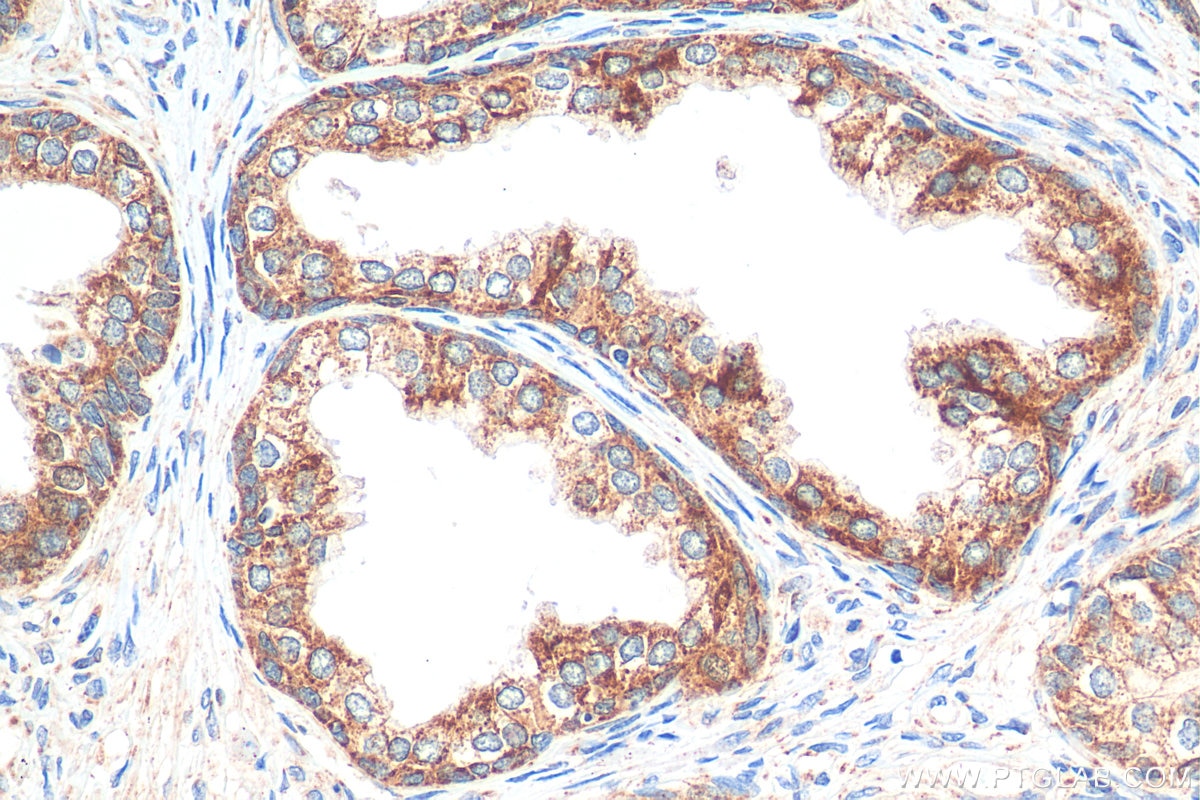Immunohistochemistry (IHC) staining of human prostate cancer tissue using SIRT3 Recombinant antibody (82210-1-RR)