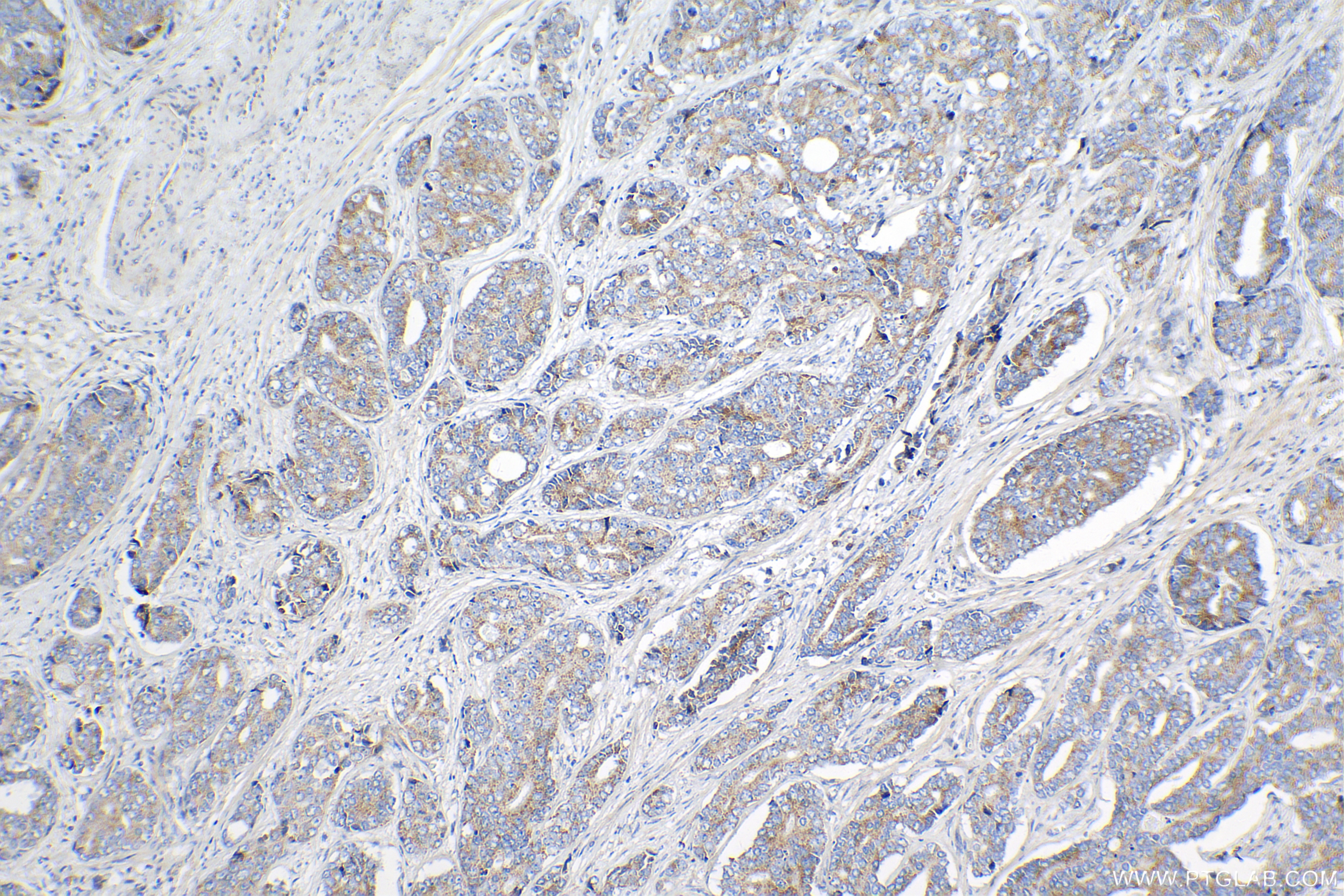 Immunohistochemistry (IHC) staining of human prostate cancer tissue using SIRT3 Recombinant antibody (82210-1-RR)
