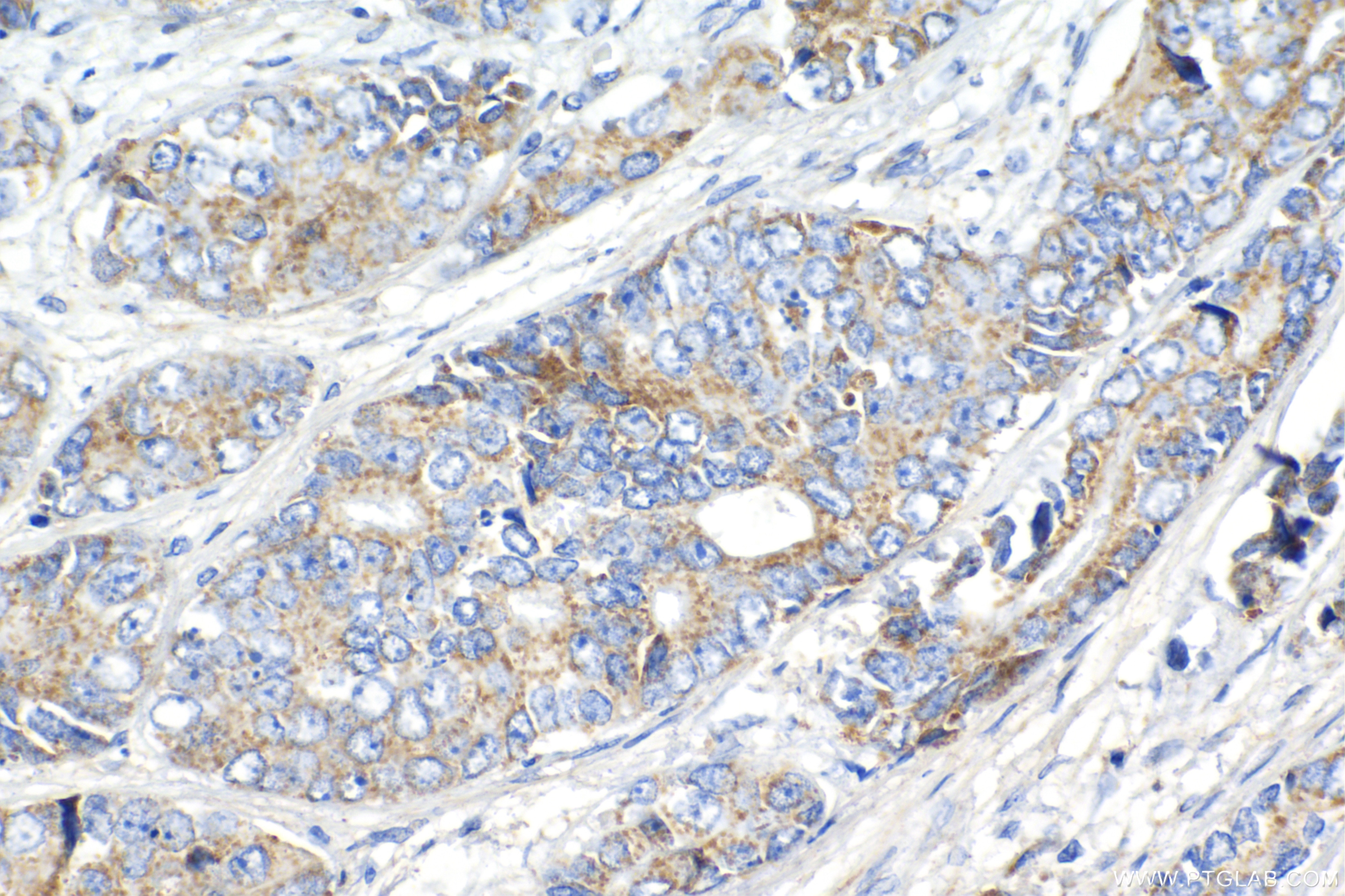 Immunohistochemistry (IHC) staining of human prostate cancer tissue using SIRT3 Recombinant antibody (82210-1-RR)
