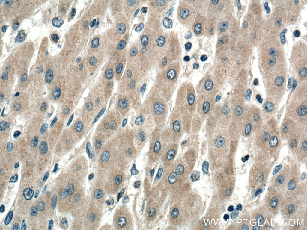 Immunohistochemistry (IHC) staining of human liver cancer tissue using SIRT5 Monoclonal antibody (67257-1-Ig)