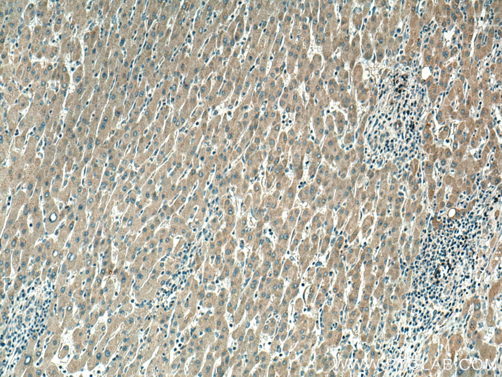 Immunohistochemistry (IHC) staining of human liver cancer tissue using SIRT5 Monoclonal antibody (67257-1-Ig)