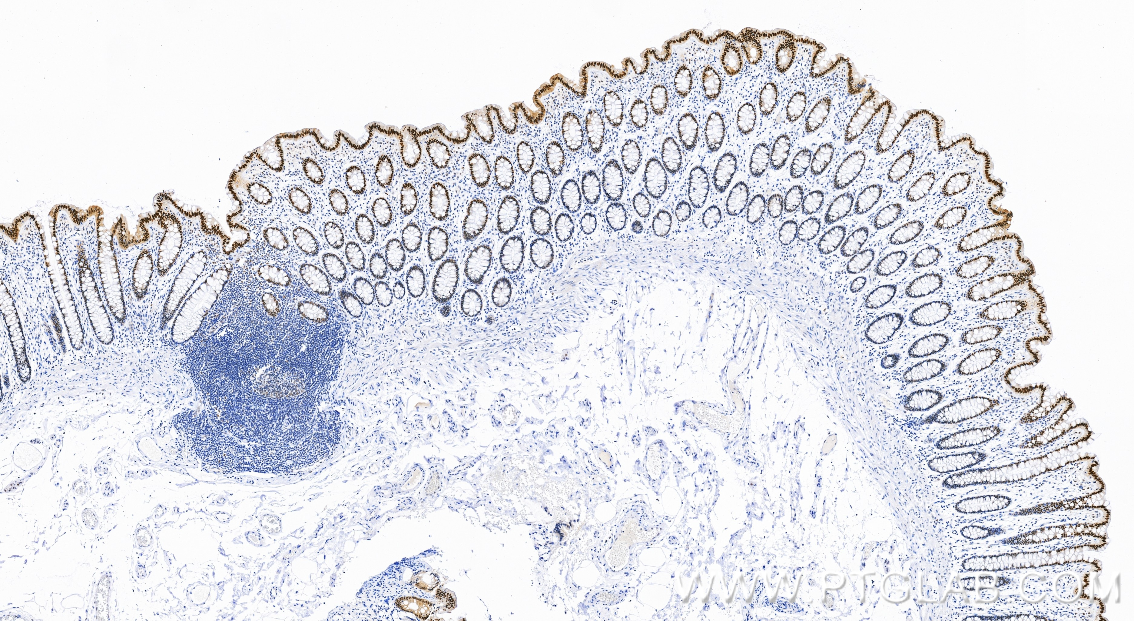 IHC staining of human colon using 87677-3-RR Immunohistochemistry (IHC) staining of human colon tissue using SIRT6 Recombinant monoclonal antibody (87677-3-RR)