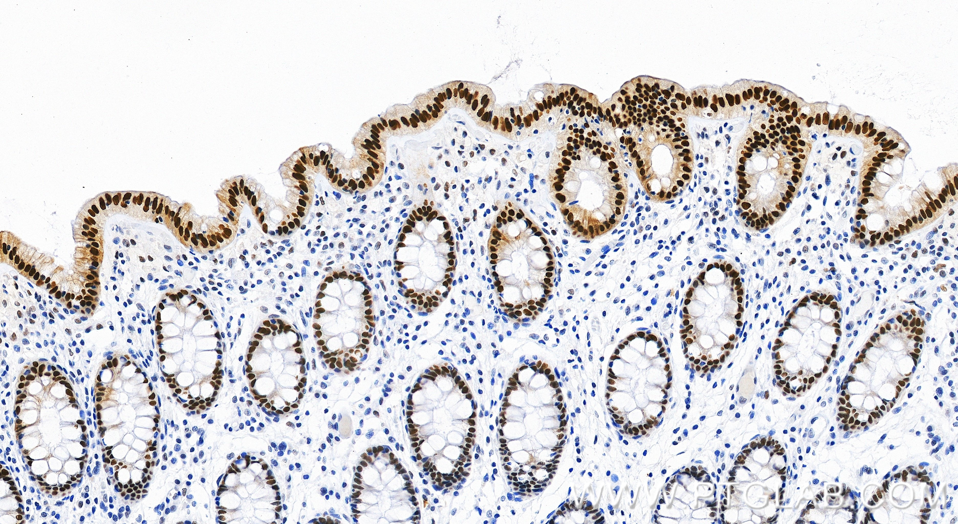 IHC staining of human colon using 87677-3-RR Immunohistochemistry (IHC) staining of human colon tissue using SIRT6 Recombinant monoclonal antibody (87677-3-RR)